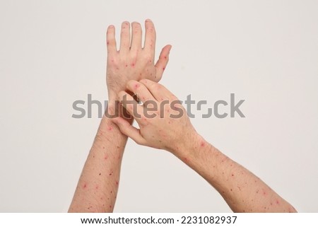Man with rash suffering from monkeypox virus on beige background, closeup
