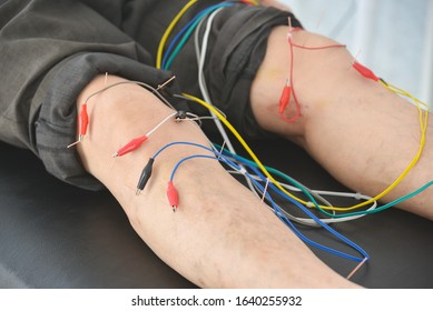 A man recieving electro acupuncture at knee and legs for relief pain ,Alternative medicine concept.