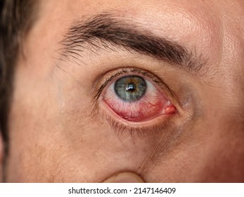 Man With Red Eye, Macro Shot. Conjunctivitis Infection
