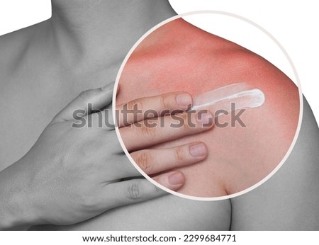 A man with reddened, itchy skin after sunburn applies a cream on the shoulder. Skin care and protection from the sun's ultraviolet rays.