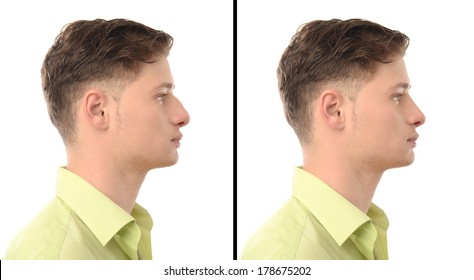 Man with rhinoplasty. Before and after photos of a young man with nose job plastic surgery.