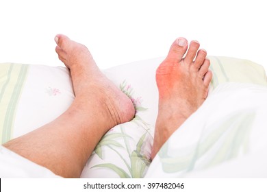 Man with right foot swollen and painful gout inflammation resting on bed