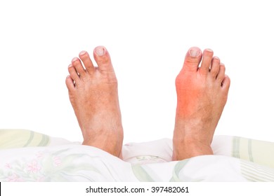 Man With Right Foot Swollen And Painful Gout Inflammation Resting On Bed