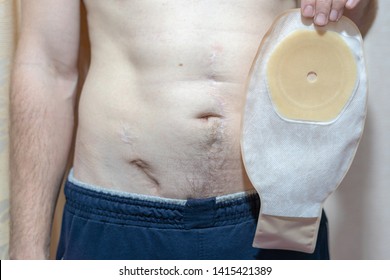 94 Ostomy pouching system Images, Stock Photos & Vectors | Shutterstock