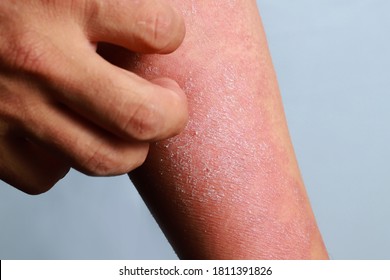 Man scratch the itch with hand, elbow itching, allergic rash dermatitis eczema skin of patient hand.