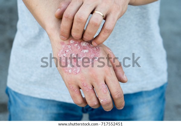 Man scratch oneself,\
dry flaky skin on hand with psoriasis vulgaris, eczema and other\
skin conditions like fungus, plaque, rash and patches. Autoimmune\
genetic disease.