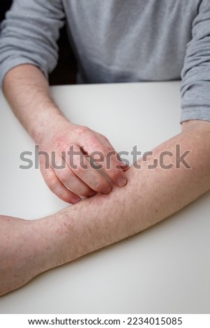 man scratching his arm with red itchy rash, allegry, dermatitis or other skin illness with painful symptoms. Dermatology and skin health care Stock photo © 