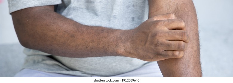 Man Scratching Suffering From Itching Arm Skin; Sick African Man Scratching His Skin With Allergy, Rash, Ringworm, Tinea Corporis Problem; Skin Care, Dermatology Concept; Adult Black African Man Model