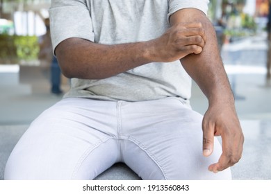 Man Scratching Suffering From Itching Arm Skin; Sick African Man Scratching His Skin With Allergy, Rash, Ringworm, Tinea Corporis Problem; Skin Care, Dermatology Concept; Adult Black African Man Model