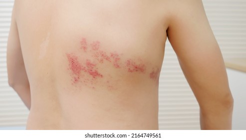 man with shingles disease on skin and he feel very painful - Shutterstock ID 2164749561