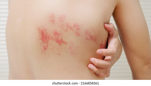 Man With Shingles Disease On Skin And He Feel Very Painful