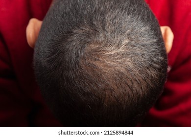 Man Showing Bald Patches On The Top Of Scalp Suffering From Androgenic Alopecia.