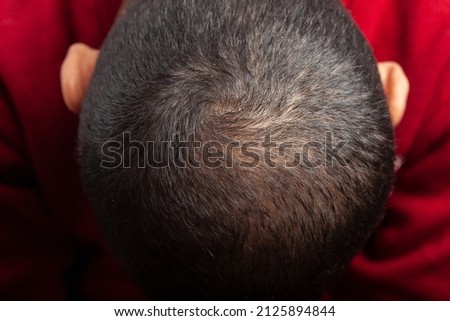 Man showing bald patches on the top of scalp suffering from androgenic alopecia.