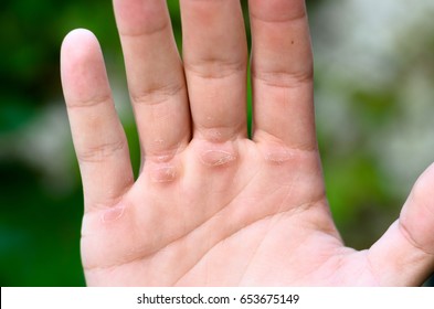 Man Showing His Hand With Callus