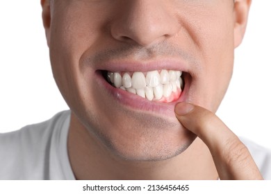 Man Showing Inflamed Gums On White Background, Closeup