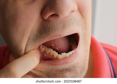 Man is showing tooth in mouth with a dental abscess fistula on gum, closeup view. Tooth with a temporary filling seal. Caries dental concept. Dental treatment of the internal parts of the tooth. - Shutterstock ID 2023108487