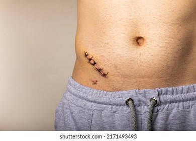 A man shows an appendicitis scar on his stomach, a scar from an appendicitis operation on his stomach. appendectomy.Medicine concept.Copy space.