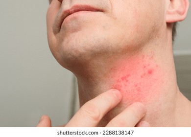 The man shows a cut and irritation on the skin of the neck after shaving. Skin irritation after shaving.