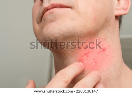 The man shows a cut and irritation on the skin of the neck after shaving. Skin irritation after shaving.