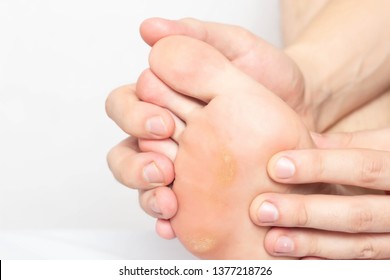 Man Shows Problem Skin On The Foot And Sole Of The Foot Dry And Callous Skin With Mazols With A Stem, Close-up, Copy Space, Disease