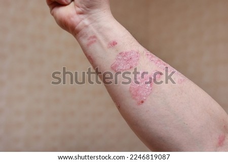Man with sick arm, dry flaky skin on his hand with vulgar psoriasis sores, allergy, eczema and other skin diseases such as fungus, plaque, rash and blemishes. Autoimmune genetic disease