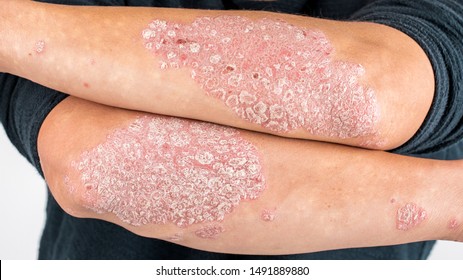 Man with sick hands, dry flaky skin on his hand with vulgar psoriasis, eczema and other skin diseases such as fungus, plaque, rash and blemishes. Autoimmune genetic disease.