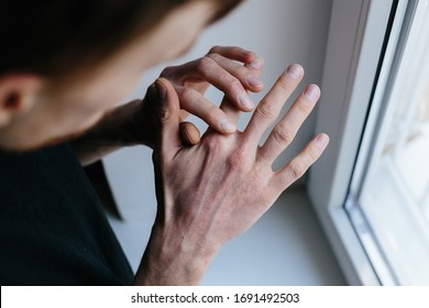 Man With Sick Hands, Dry Flaky Skin On His Hand With Vulgar Psoriasis, Eczema And Other Skin Diseases Such As Fungus, Plaque, Rash And Blemishes. Autoimmune Genetic Disease.