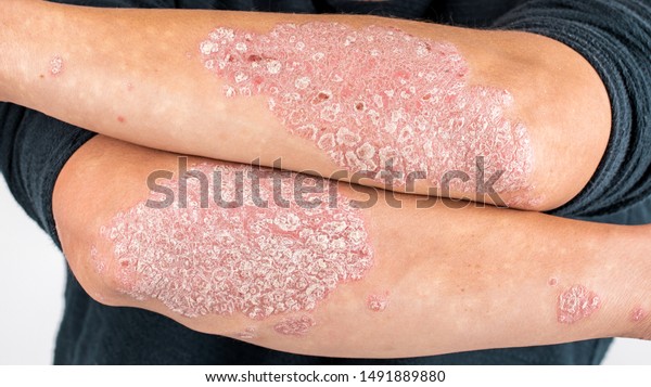 Man with sick\
hands, dry flaky skin on his hand with vulgar psoriasis, eczema and\
other skin diseases such as fungus, plaque, rash and blemishes.\
Autoimmune genetic disease.