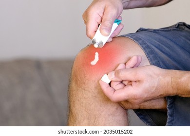 A Man Smears A Sore Knee With Ointment For The Joints.