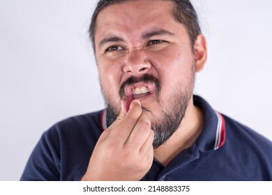 A man squeezes a mouth ulcer in a desperate attempt to numb the pain. Discomfort caused by a canker sore on the lower lip. - Shutterstock ID 2148883375