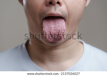 A man sticking out Fissured tongue, Bacterial infection disease tongue,The tongue is thrush.Tongue wound