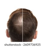 Man suffering from baldness on white background, closeup. Before and after treatment, collage