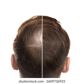 Man suffering from baldness on white background, closeup. Before and after treatment, collage
