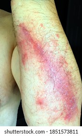 A Man Suffering From A Case Of Poison Ivy On His Left Arm. 