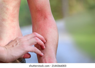 Man Suffering From Itching On Arm Skin Body And Scratching An Itchy Place. Allergic Reaction To Allergic A Caterpillar Sting Or Insect Bites, Dermatitis, Food, Drugs. Health Care Concept.