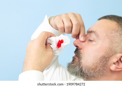 Man suffering from nosebleed or epistaxis and using paper tissue for stop bleeding. Healthcare concept