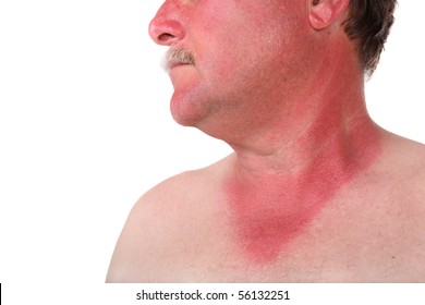 Man With A Sunburn