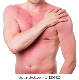 Man With A Sunburn Isolated On White Background