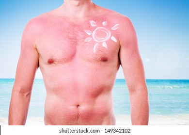 Man With A Sunburn Isolated On White Background