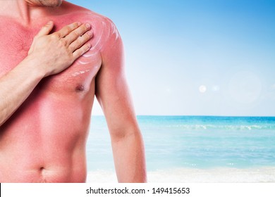 Man With A Sunburn Isolated On White Background