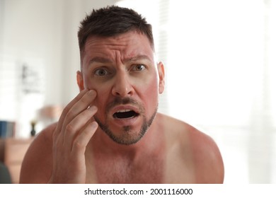 Man With Sunburn On Skin At Home