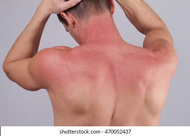 Man With Sunburn. Sun Skin Care