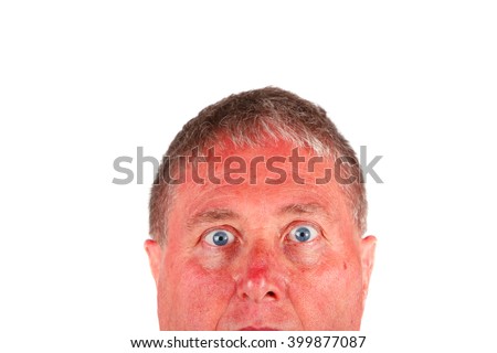 Man with a sunburned face