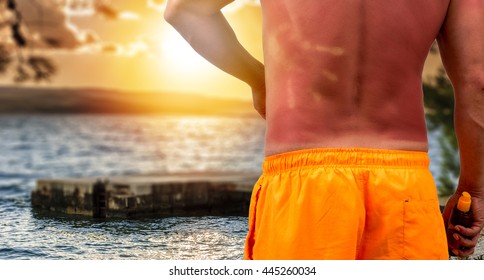 Man With Sunburned Skin And Ocean Beach With Sunset