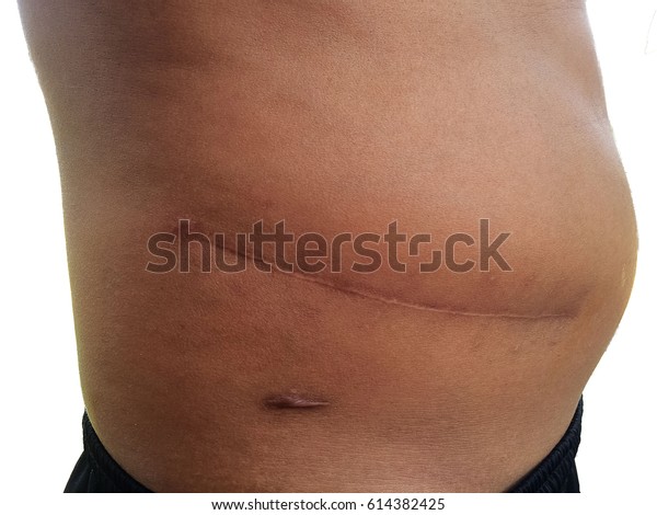 Man Surgery Scar Kidney Stone Stock Photo Edit Now 614382425