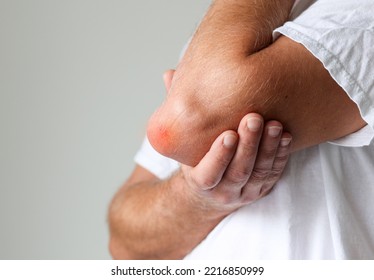 Man Swelling Erythematous Lump Pain Elbow From Olecranon Bursitis, Student Elbow Medical Condition. Inflammation Of The Bursa Located Under The Elbow Olecranon Trauma Or Repetitive Smaller Traumas. 