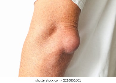 Man Swelling Erythematous Lump Pain Elbow From Olecranon Bursitis, Student Elbow Medical Condition. Inflammation Of The Bursa Located Under The Elbow Olecranon Trauma Or Repetitive Smaller Traumas. 