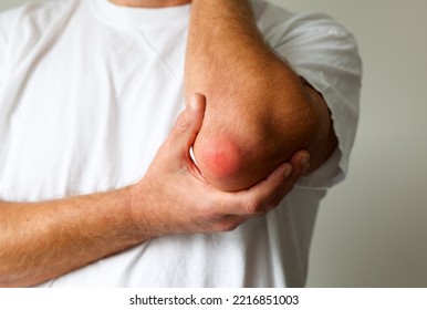 Man Swelling Erythematous Lump Pain Elbow From Olecranon Bursitis, Student Elbow Medical Condition. Inflammation Of The Bursa Located Under The Elbow Olecranon Trauma Or Repetitive Smaller Traumas. 