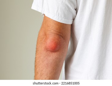 Man Swelling Erythematous Lump Pain Elbow From Olecranon Bursitis, Student Elbow Medical Condition. Inflammation Of The Bursa Located Under The Elbow Olecranon Trauma Or Repetitive Smaller Traumas. 