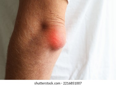 Man Swelling Erythematous Lump Pain Elbow From Olecranon Bursitis, Student Elbow Medical Condition. Inflammation Of The Bursa Located Under The Elbow Olecranon Trauma Or Repetitive Smaller Traumas. 